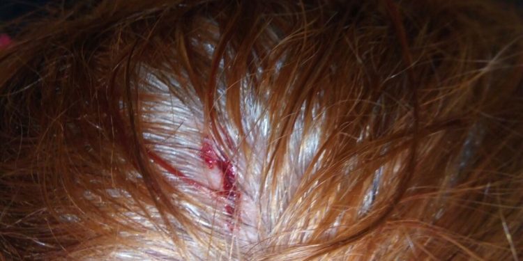 La aficionada herida por un cascote en Balaídos traslada su queja al Concello